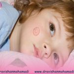 علائم عفونت قارچی پوست در کودکان