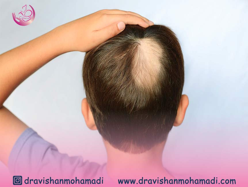 Alopecia areata or regional baldness of the child's head